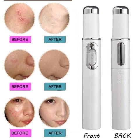 FDA-Cleared Blue Light Acne Killer | No-Skin-Contact Design