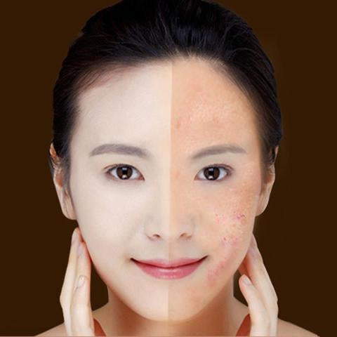 FDA-Cleared Blue Light Acne Killer | No-Skin-Contact Design