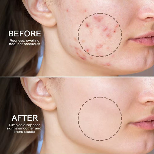 Snmifun - Bee Anti-Acne Gel